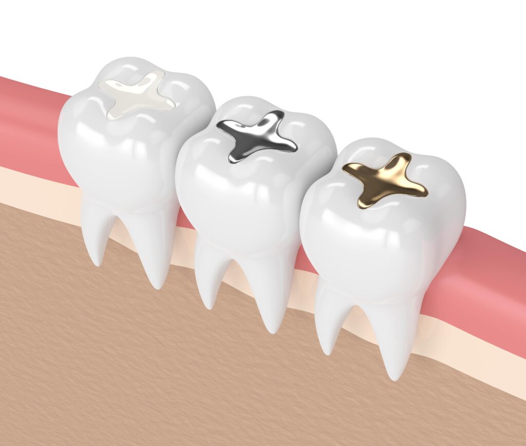 Dental Fillings