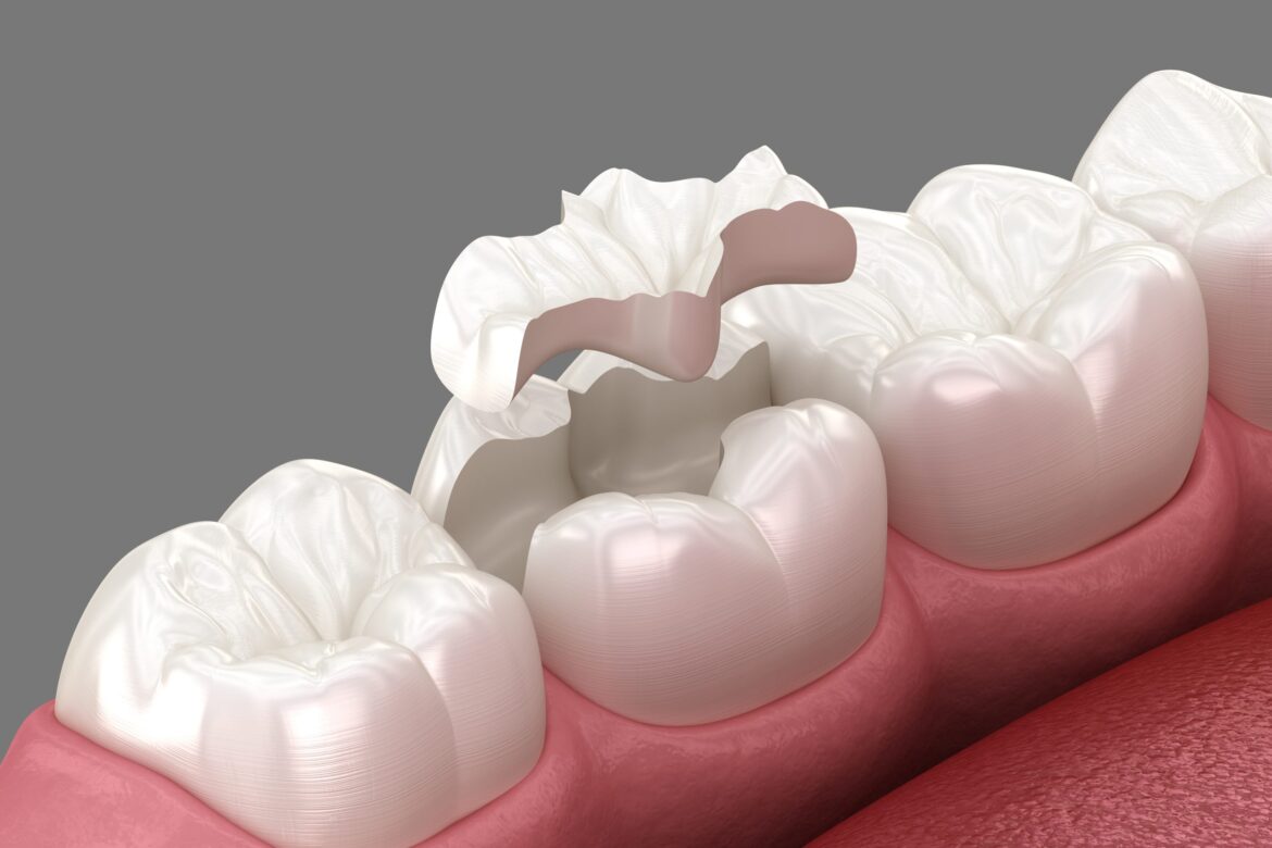 Restoring Tooth Strength and Function with Long-Lasting Dental Fillings